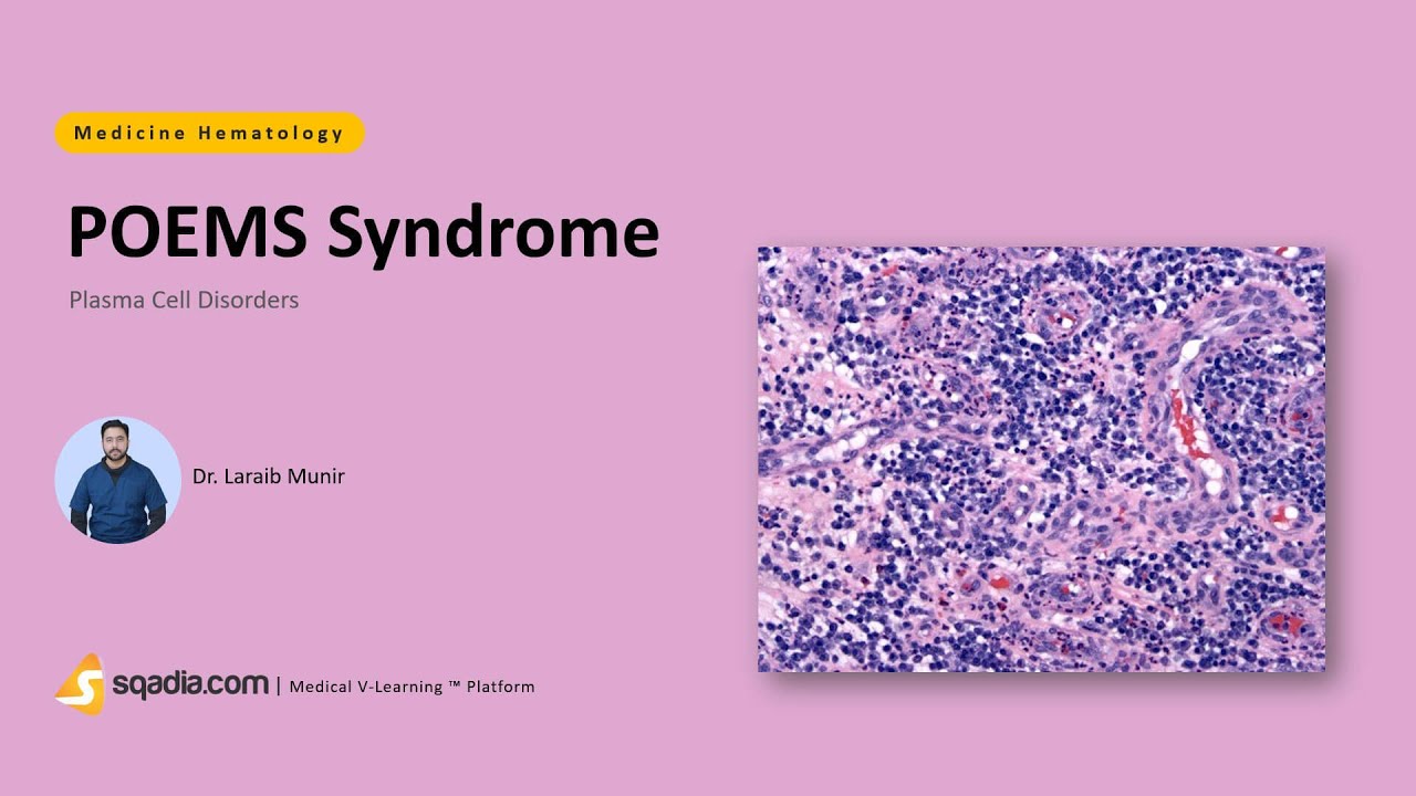 Plasma Cell Disorders | POEMS Syndrome