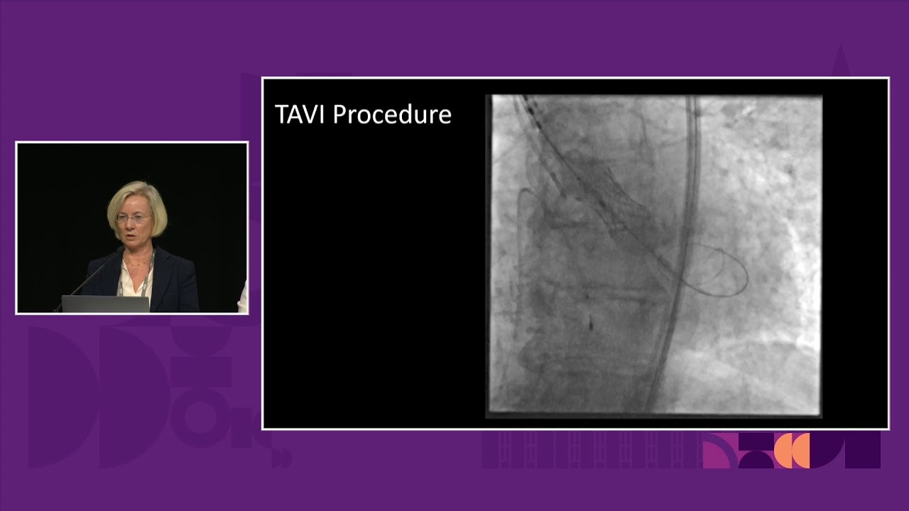 New frontiers in TAVI: have we reached them? PCR London Valves 2024