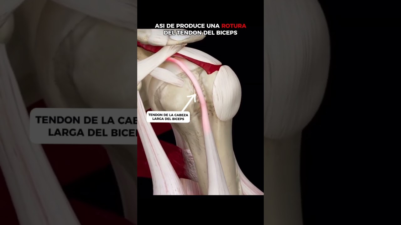 LESION BICEPS!  #tendinitis #biceps #hombro #ejerciciosencasa #ejerciciosmovilidad #anatom&iacute;a