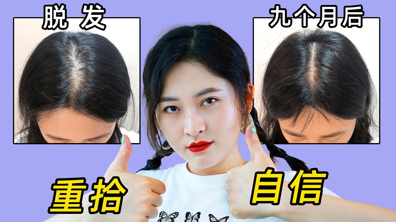 治疗9个月，我的脱发终于得救了，秃头女孩亲测有效。