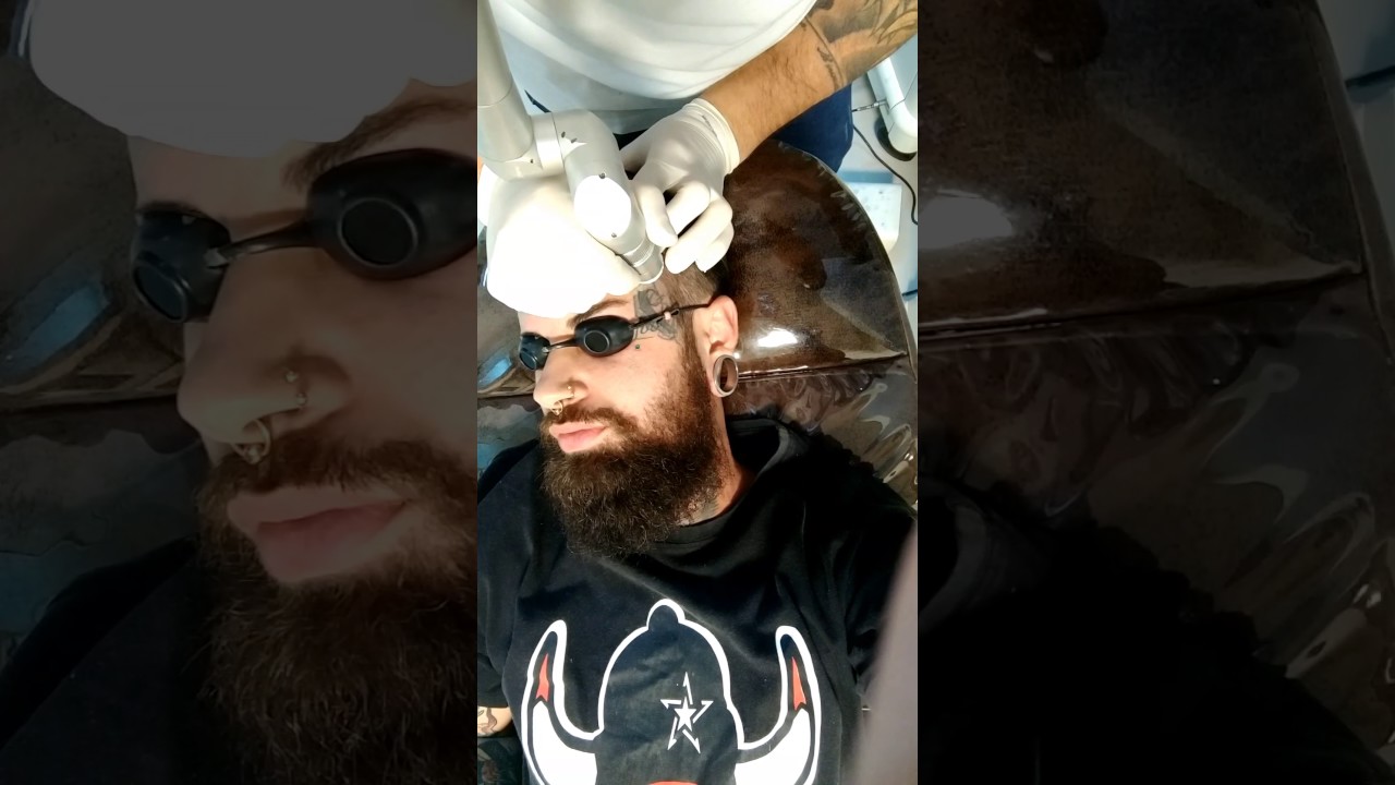Remoção de Tatuagem a laser Rosto