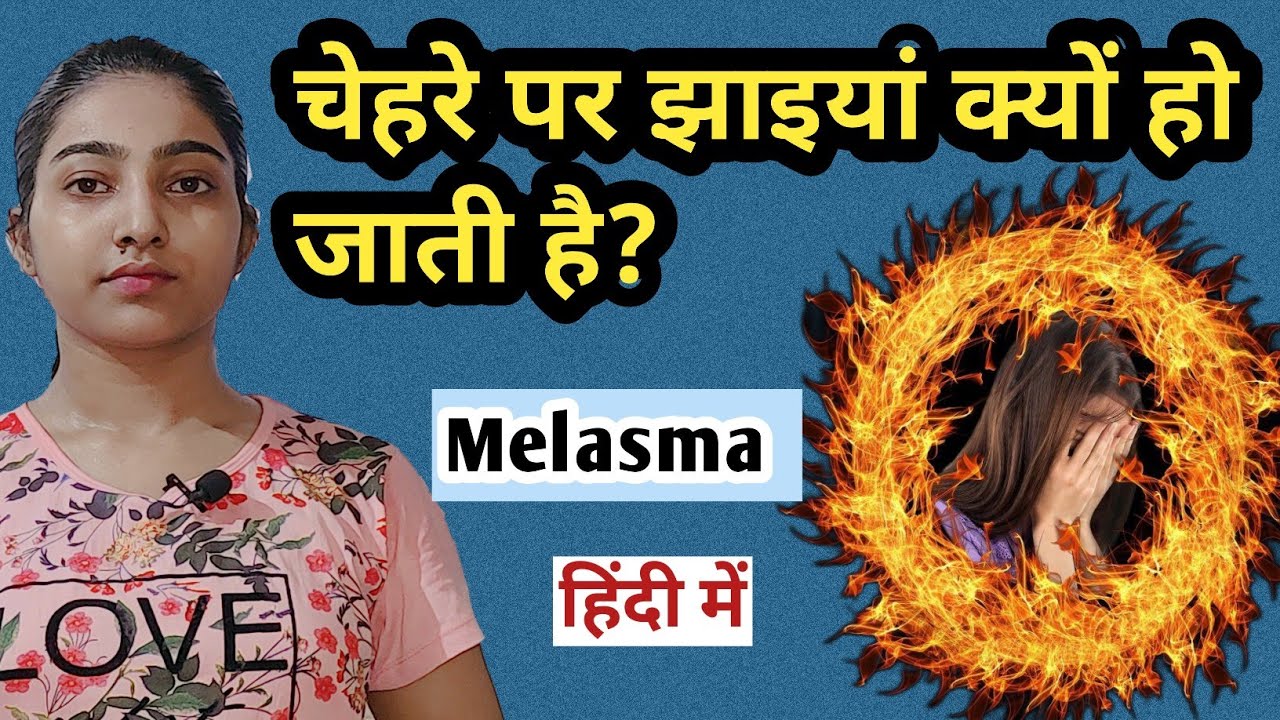 चेहरे पर झाइयां और दाग धब्बे क्यों हो जाते हैं?|Melasma causes, symptoms and treatment in hindi