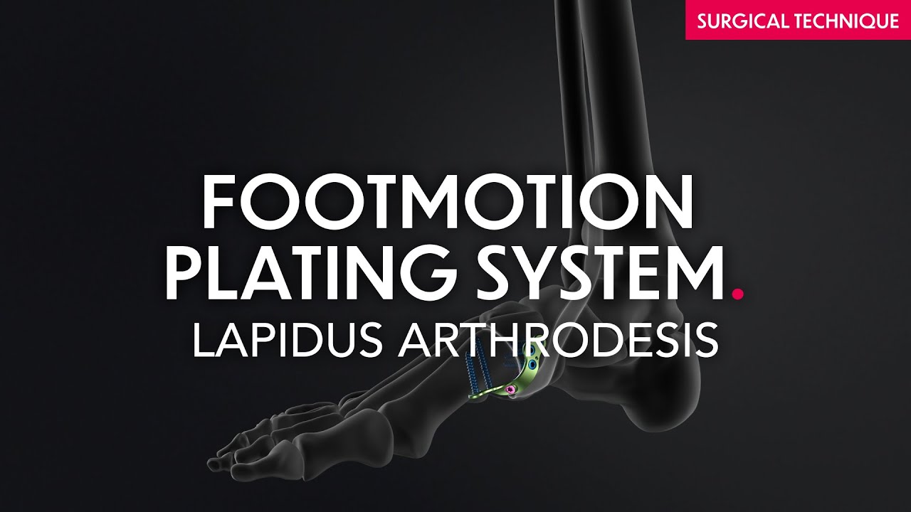 Footmotion Plating Sytem - Lapidus Arthrodesis - Surgical technique