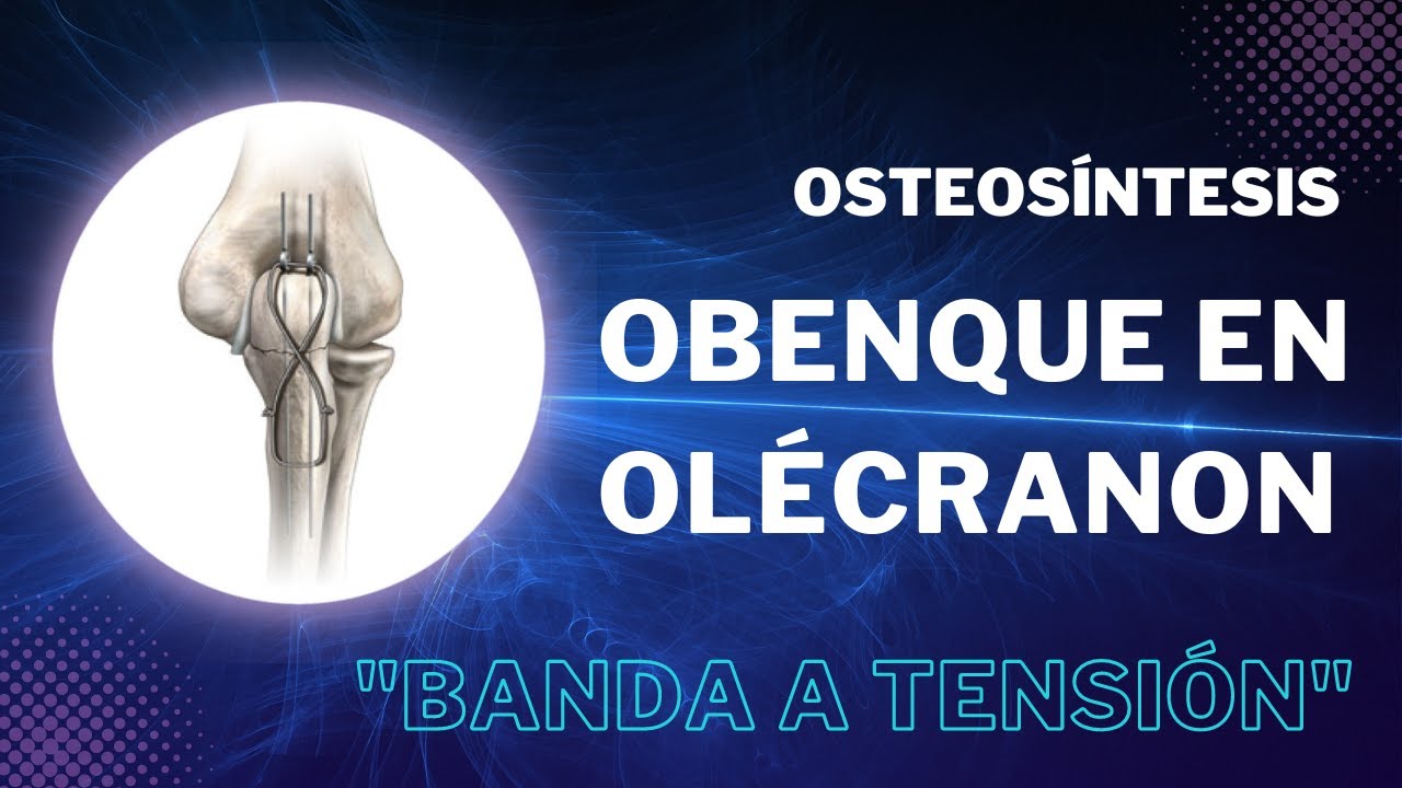 Osteos&iacute;ntesis - Obenque en ol&eacute;cranon 