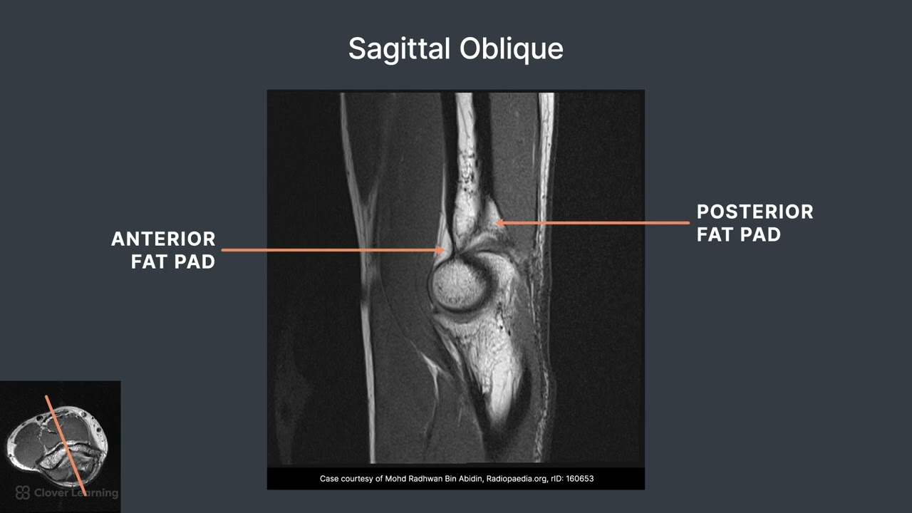 MRI Cross Sectional Anatomy of the Elbow and Common Pathologies