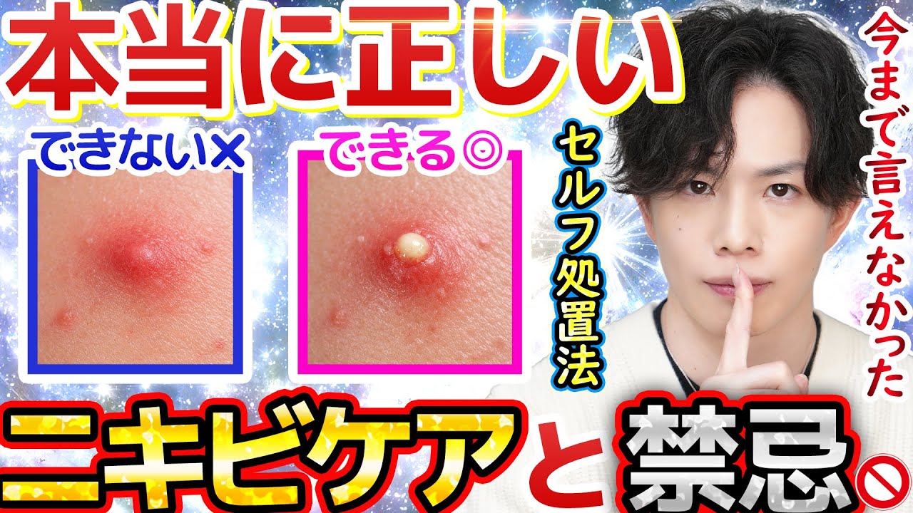 【ニキビのセルフ処置法】『正しく潰す』コツと使用器具を初解説！SNSで波紋のニキビ問題についてお話しました。【第一推奨は皮膚科！だけど行く時間がない人へ】