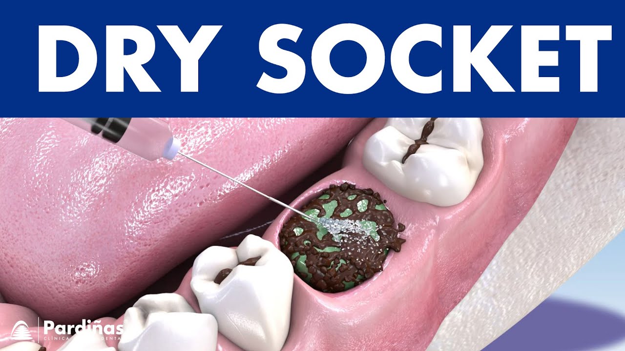 DRY SOCKET - Infection after tooth extraction: causes and treatment &copy;