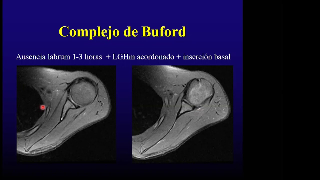 Radiologia del labrum glenoideo