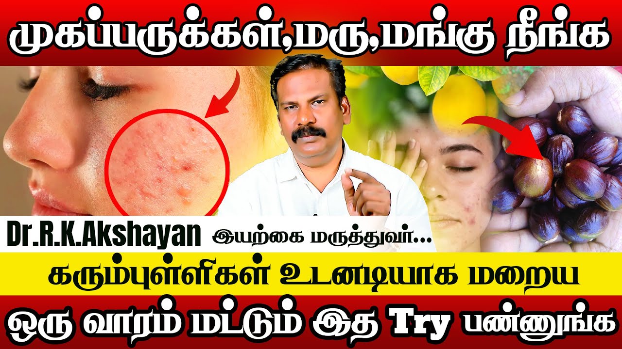 பருக்கள் ,கரும்புள்ளிகள் நீக்கும் இயற்கைமருத்துவம் |Dr.RK.Akshayan | Acne&Pimples