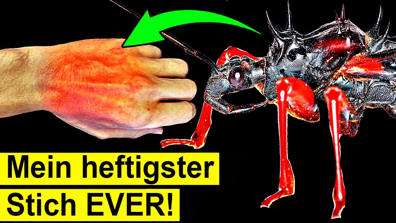Was passiert wenn dich die gr&ouml;&szlig;te Raubwanze der Welt sticht?