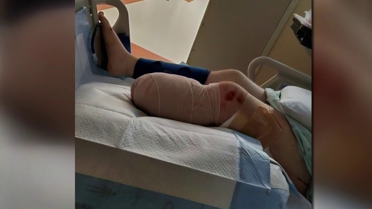 Motorcyclist forced to have leg amputated
