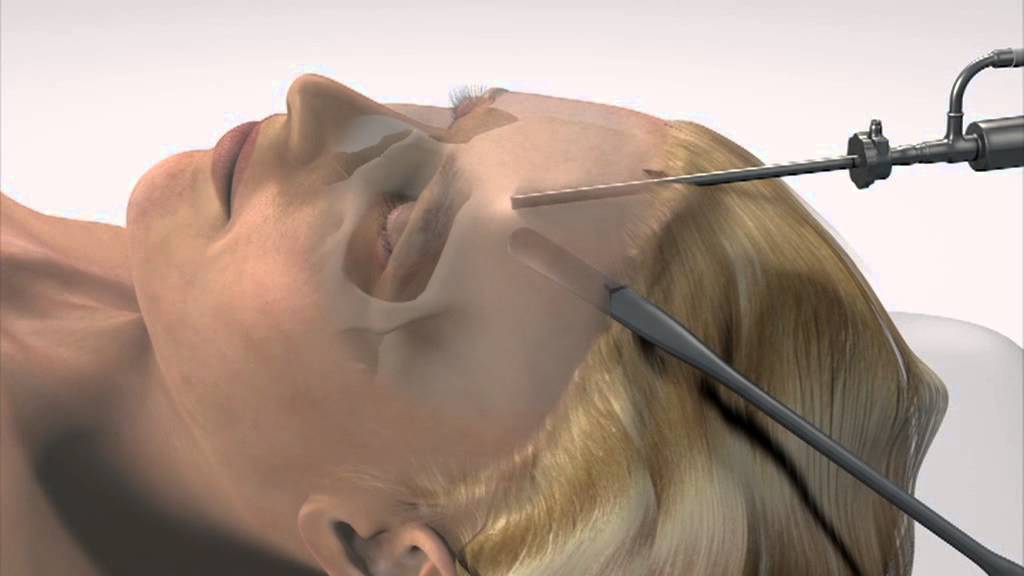 3-D animatie: Voorhoofdslift