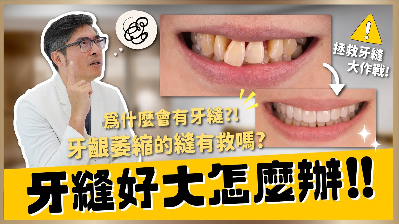 【美學修復 #3】牙縫好大怎麼辦！牙齦萎縮造成的牙縫還有救嗎？解析出現牙縫的5大原因與拯救的5種方法｜【祐民牙醫－隱適美旗艦店】鑽石級楊大為醫師