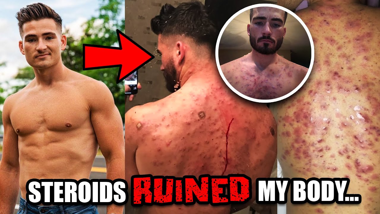 Steroids RUINED His Body… My Analysis