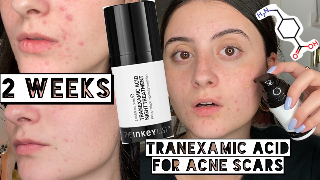 TESTING THE INKEY LIST TRANEXAMIC ACID NIGHT TREATMENT ON MY ACNE SCARS For 2 weeks