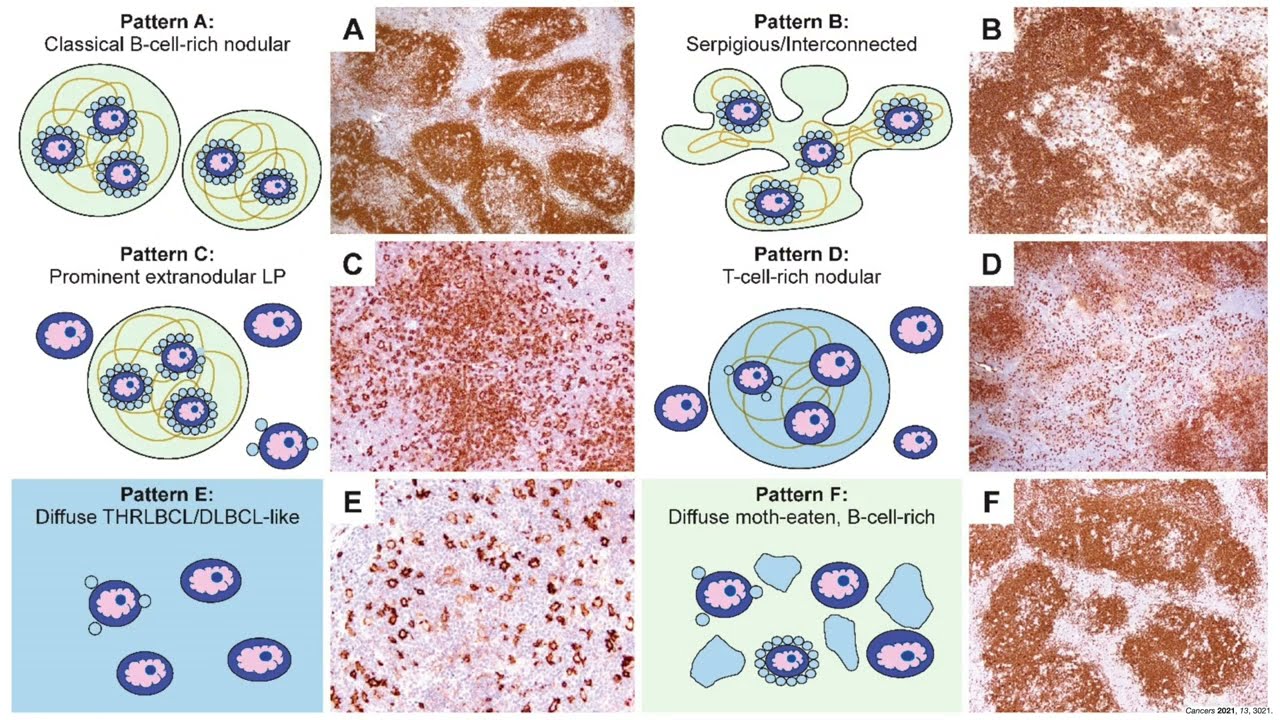 Nodular Lymphocyte Predominant Hodgkin Lymphoma