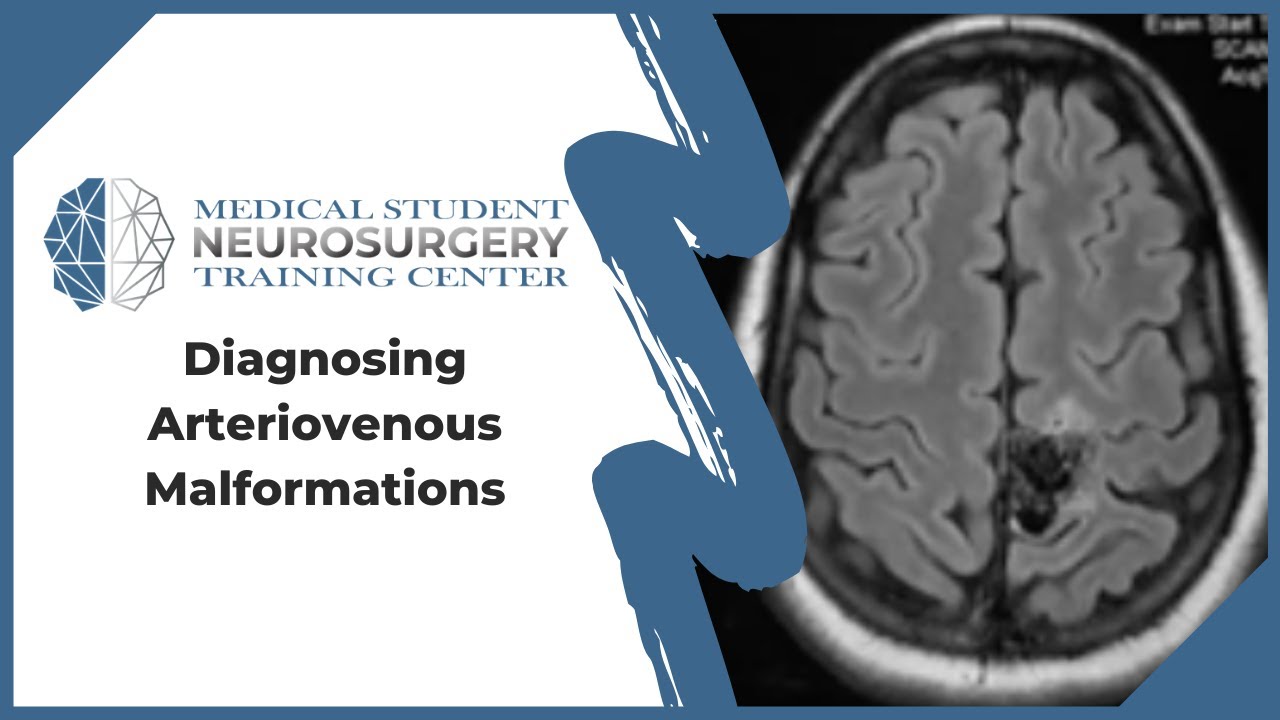 Diagnosing Arteriovenous Malformations