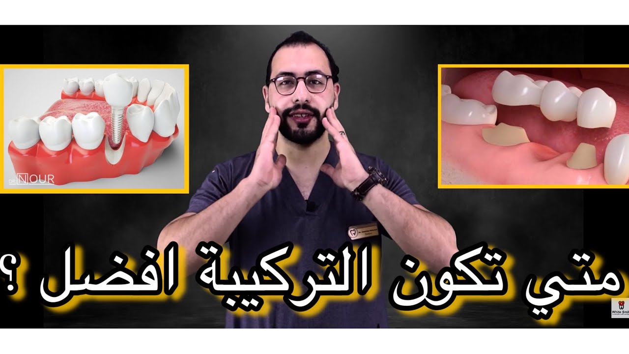 متي تكون التركيبات الثابته افضل لك من الزراعة ؟!  زراعة الاسنان والتركيبات الجزء 2