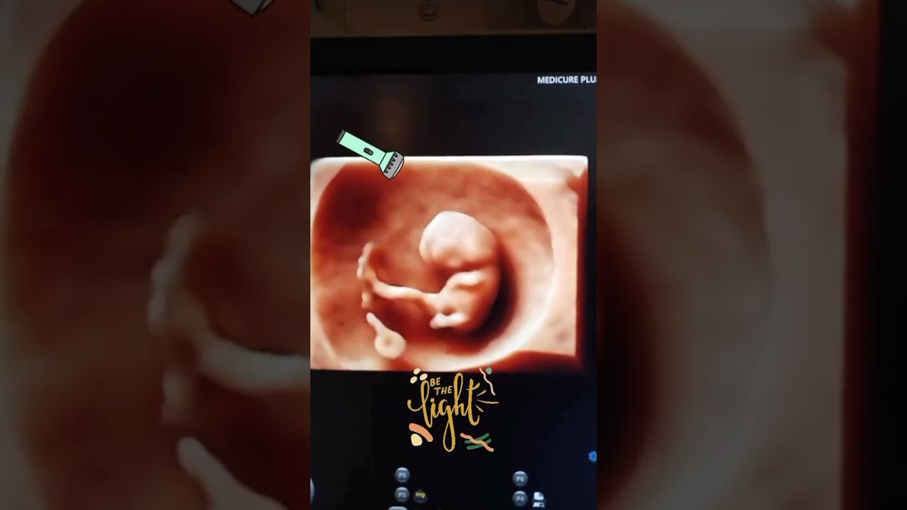 #fetalecho #anatomy #obstetrician #fetalmedicine #fetus #isuog #obstetrics