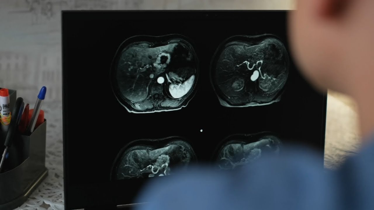 More people are living 5 years after cancer diagnosis, new data shows