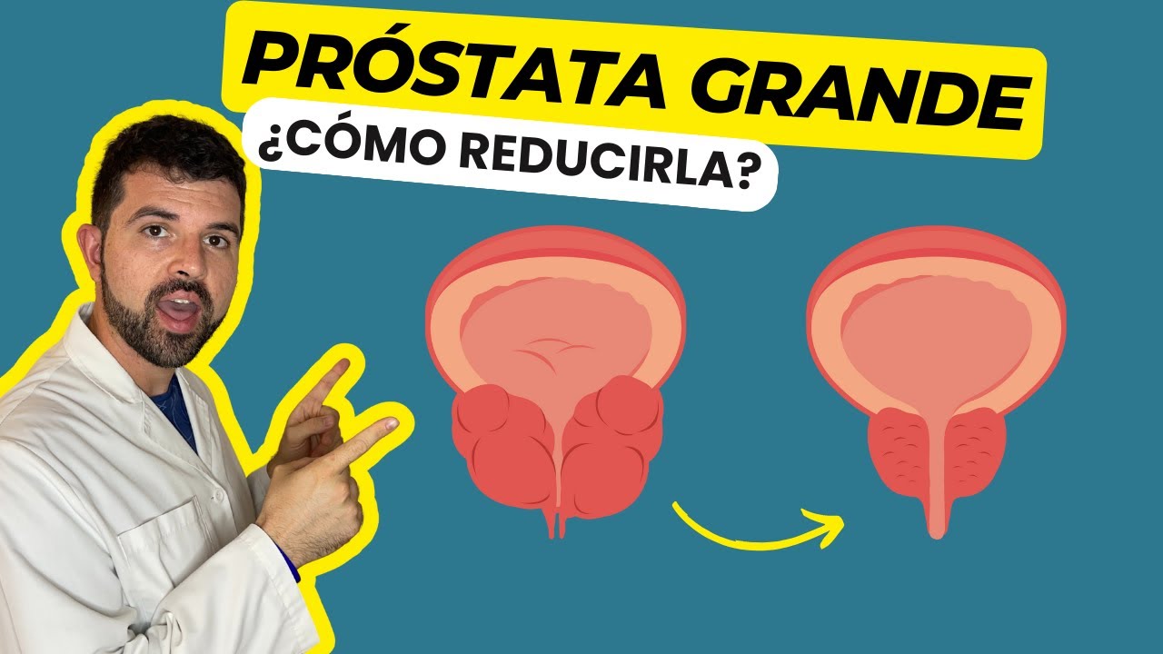 PROSTATA GRANDE Descubre C&oacute;mo Reducir la Pr&oacute;stata