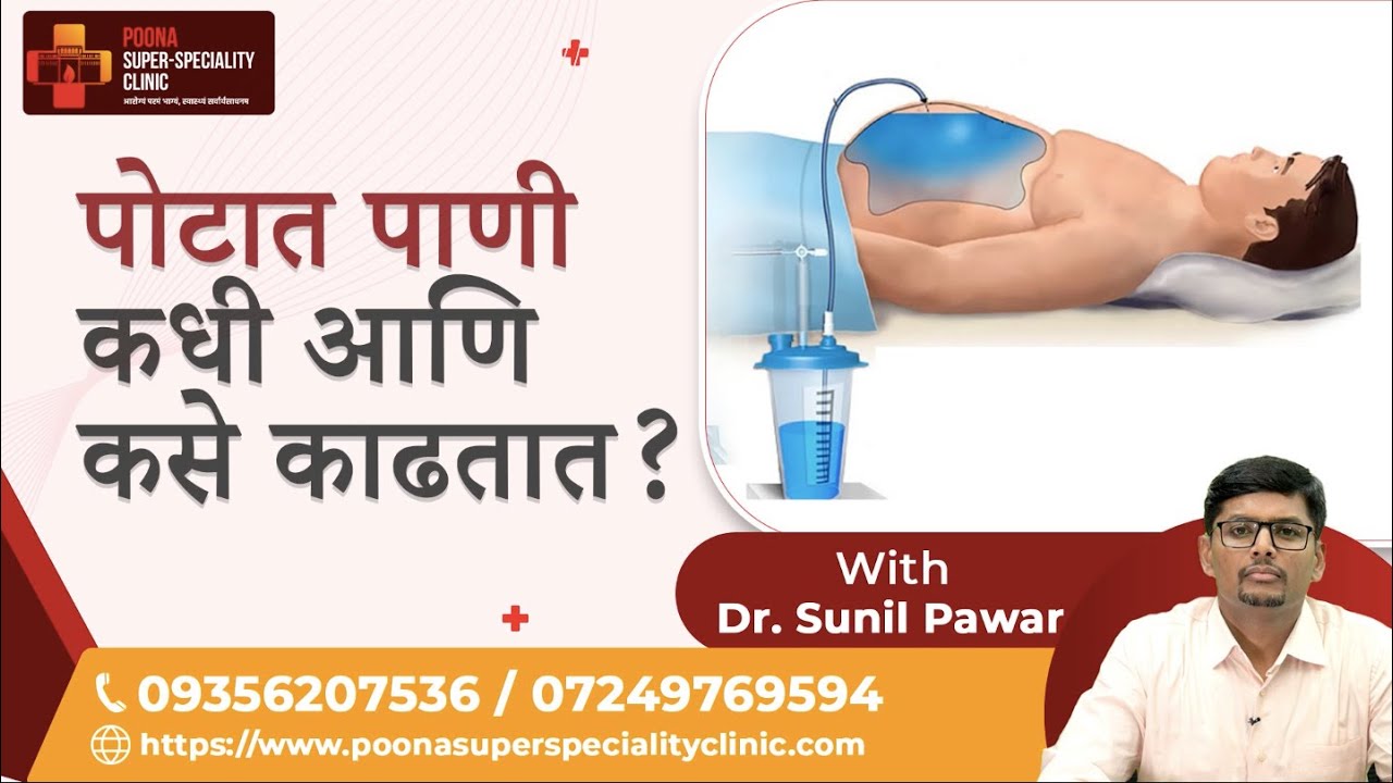 पोटातील पाणी कसं आणि कधी काढतात?|Dr. Sunil Pawar| #ascites #gastrodoctorinpune #gastrocare