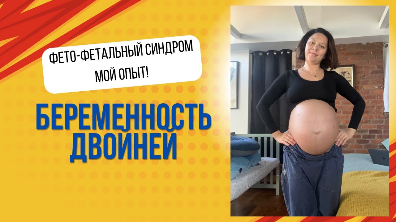 Беременность двойней. Фето-фетальный синдром. Мой опыт.