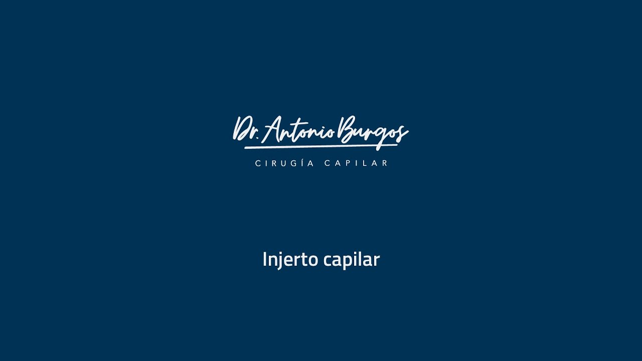Todo sobre el trasplante de pelo | INJERTO CAPILAR