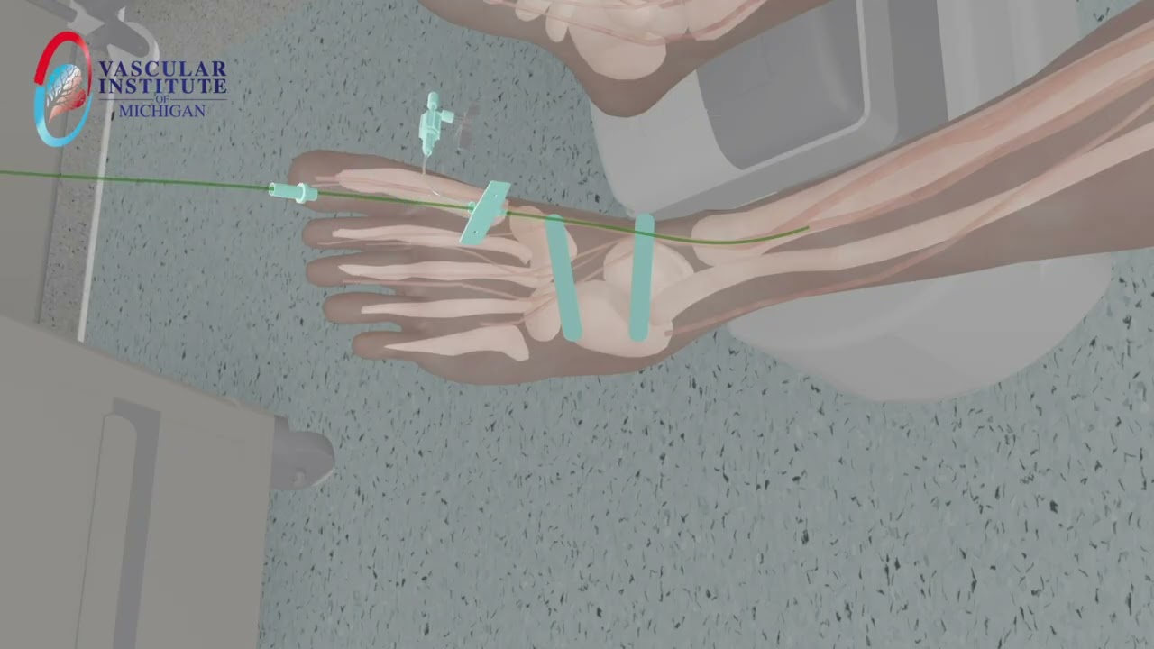 3D Medical Animation &ndash; Genicular Artery Embolization (Knee Osteoarthritis Treatment)