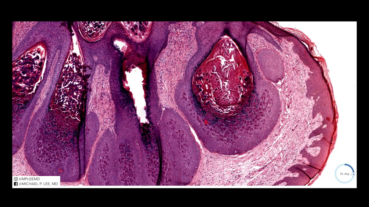 Myrmecia vs Molloscum. Dermpath Made Easy. Viral Video.