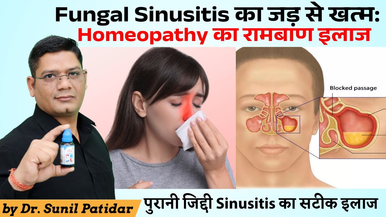 Fungal Sinusitis Homeopathic Treatment | True treatment for chronic stubborn sinusitis | Dr Patidar