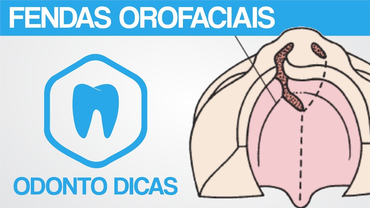 FENDAS OROFACIAIS  | ODONTO DICAS