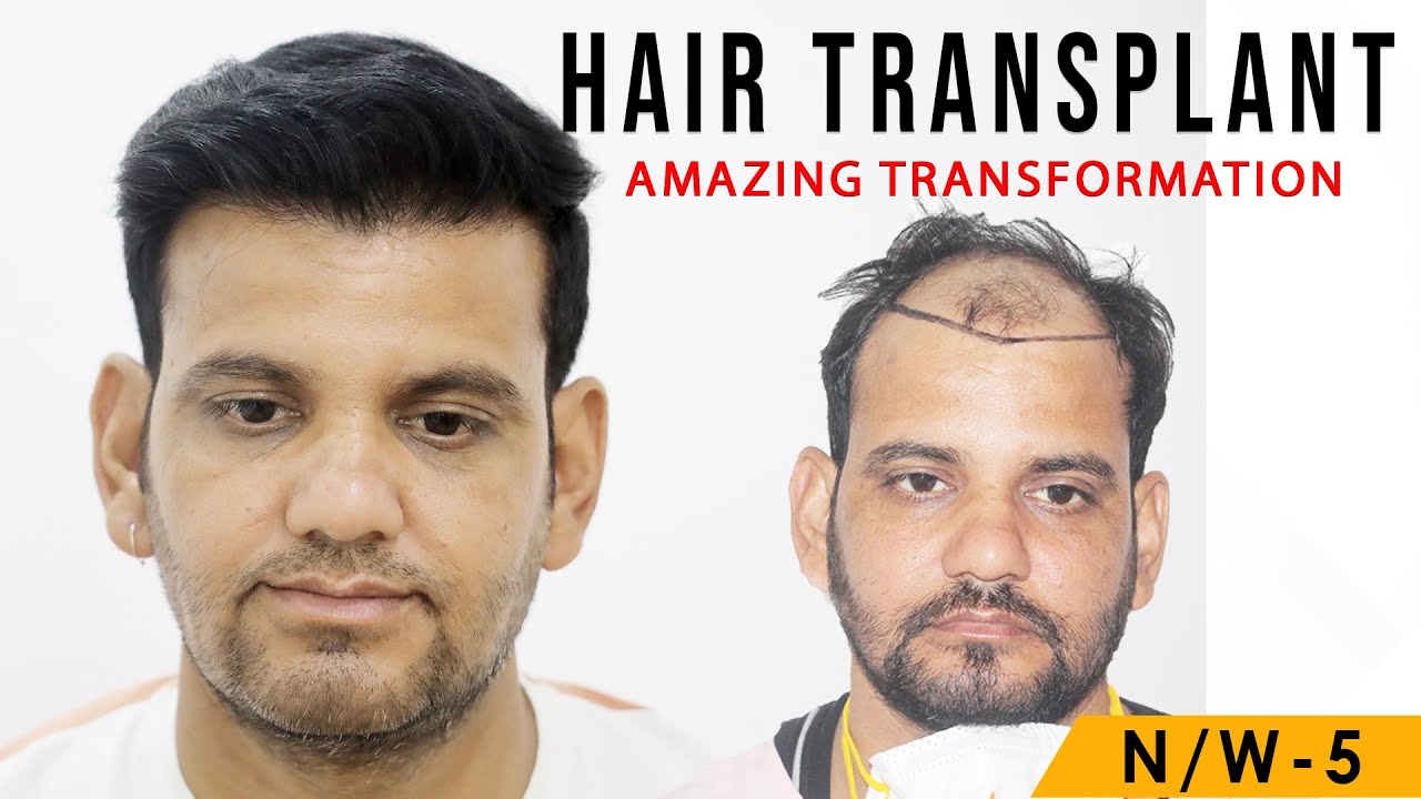 The Best Hair Transplant in India in best Cost | Medispa India | Dr Suneet Soni