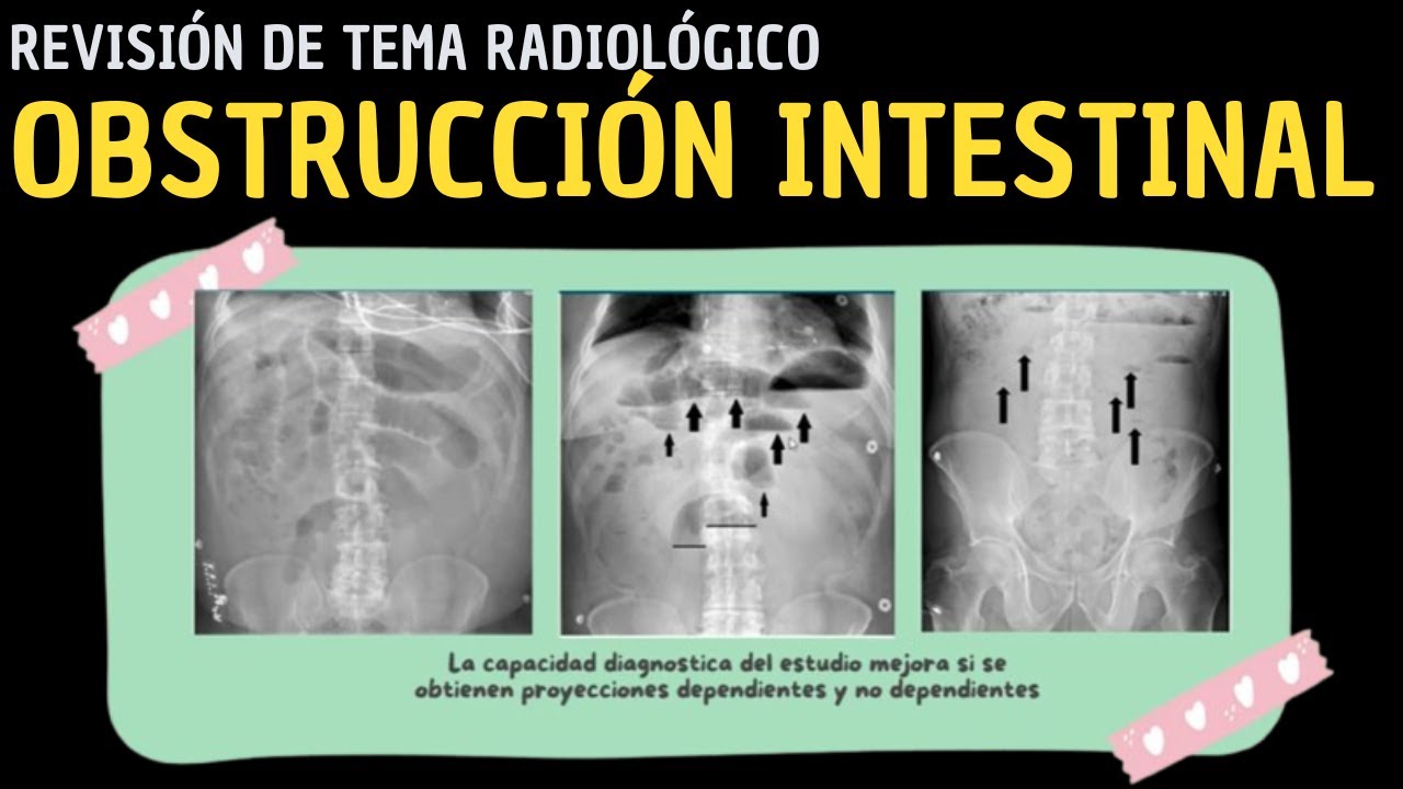 Revisión de Tema 84: Obstrucción intestinal.