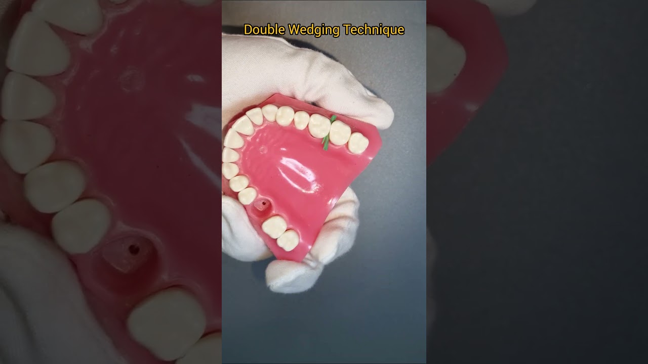 Wedging Techniques Demonstration #shorts #dental #dentist #dentistryexplained #smiledesigndental
