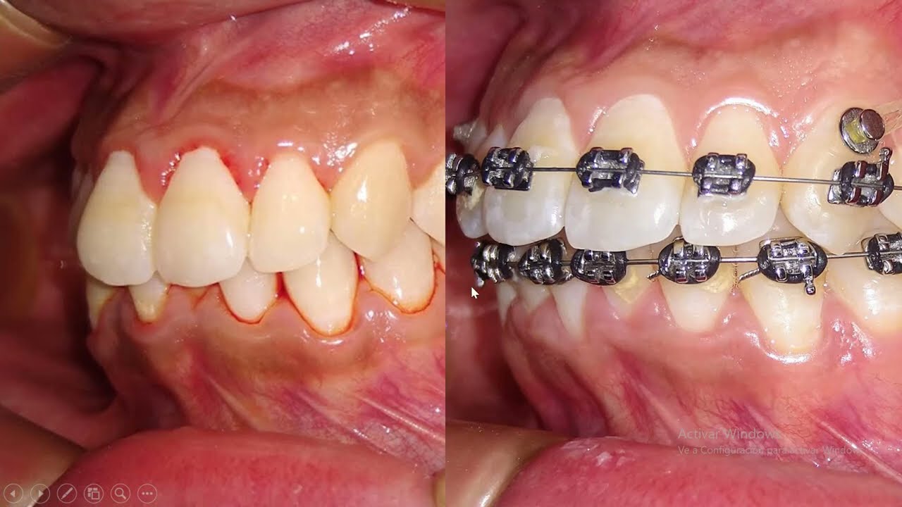 Mordida Profunda en Ortodoncia, ANTES Y DESPUÉS 👍 como se soluciona con los BITE TURBOS?