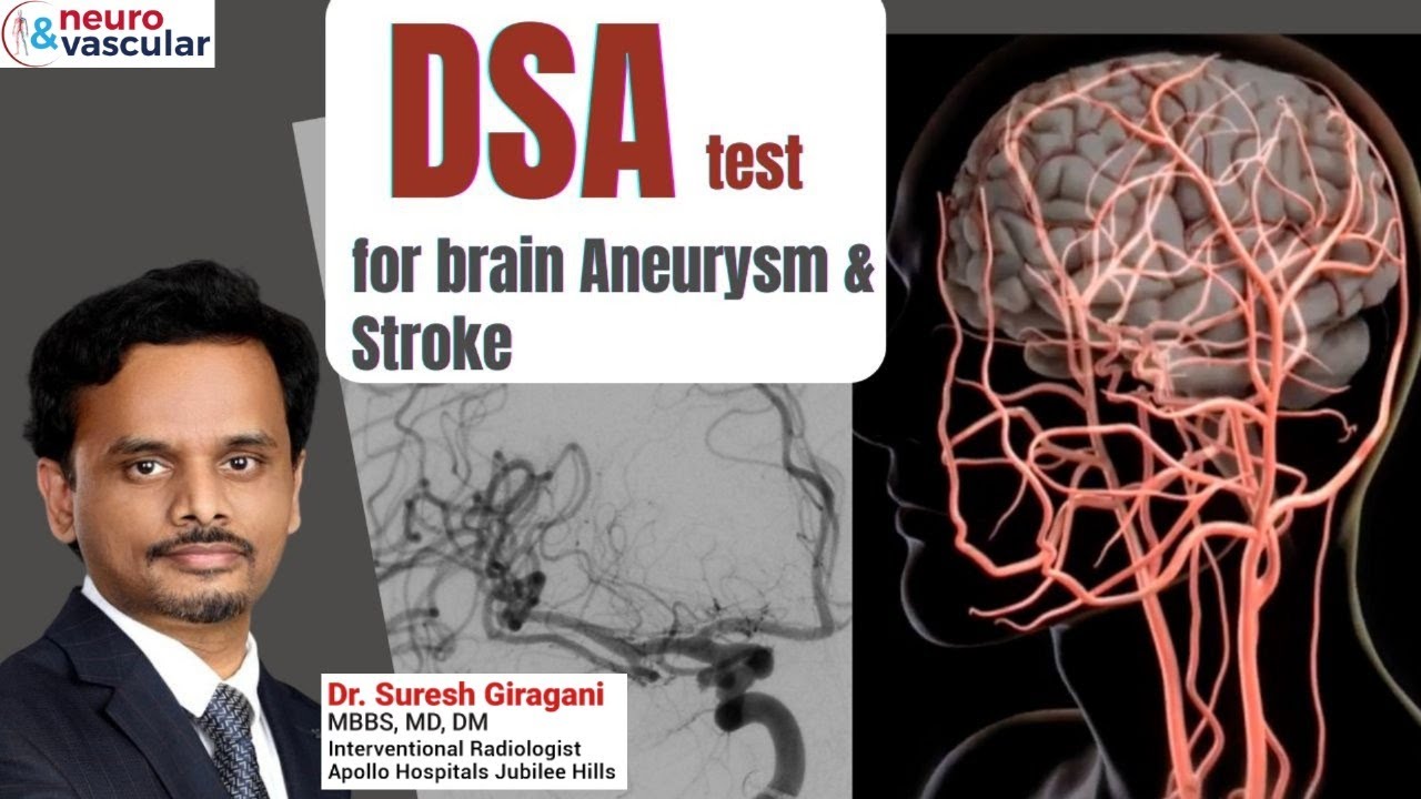 Цифровая субтракционная ангиография (DSA) для выявления аневризмы головного мозга и инсульта | До...