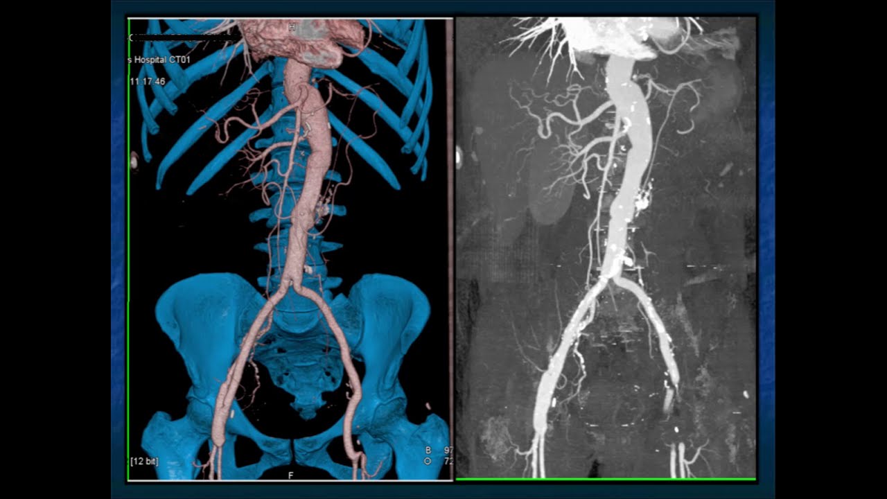 CTA of the Renal Arteries: What You Need to Know - Part 1