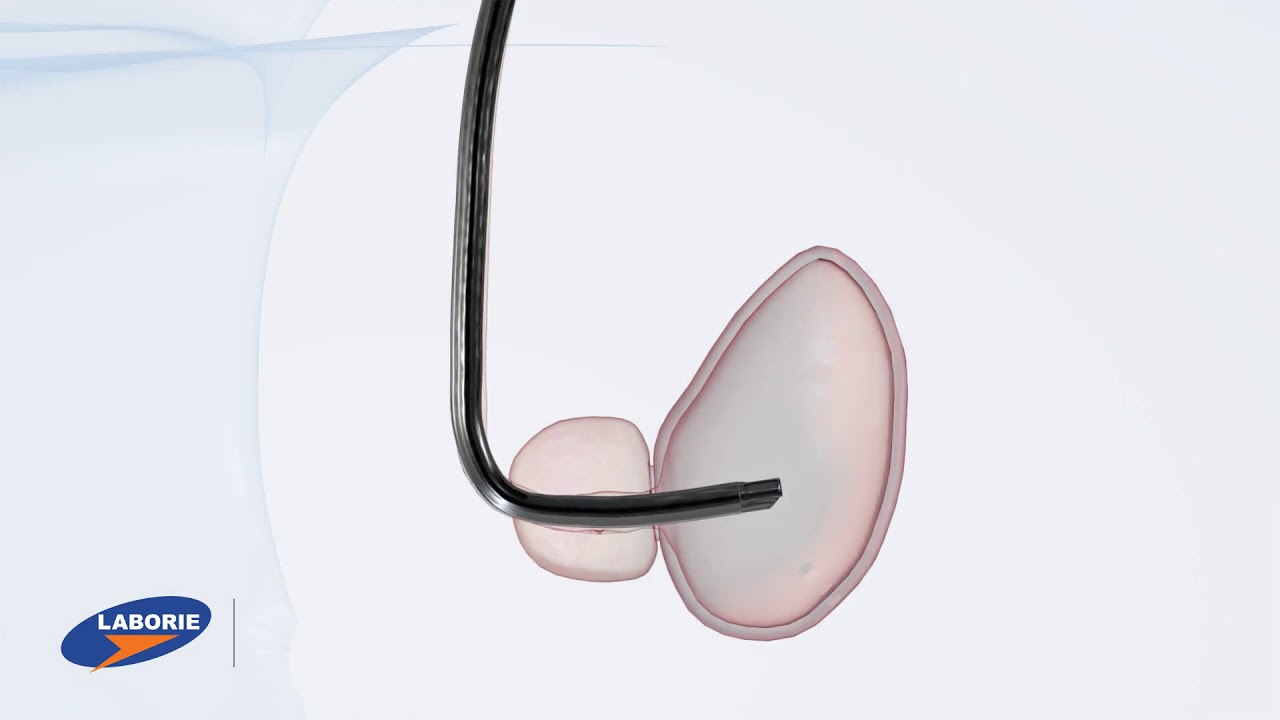 EndoSheath® Protective Barrier - Infection Prevention