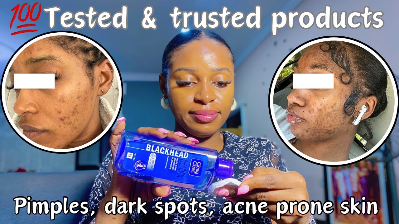 *Tested & trusted* best products for pimples & acne | affordable products for pimples and dark spots