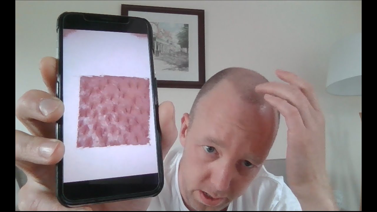 Day 7: Video Diary. 2000 FUE with Dr Ball Maitland Clinic UK