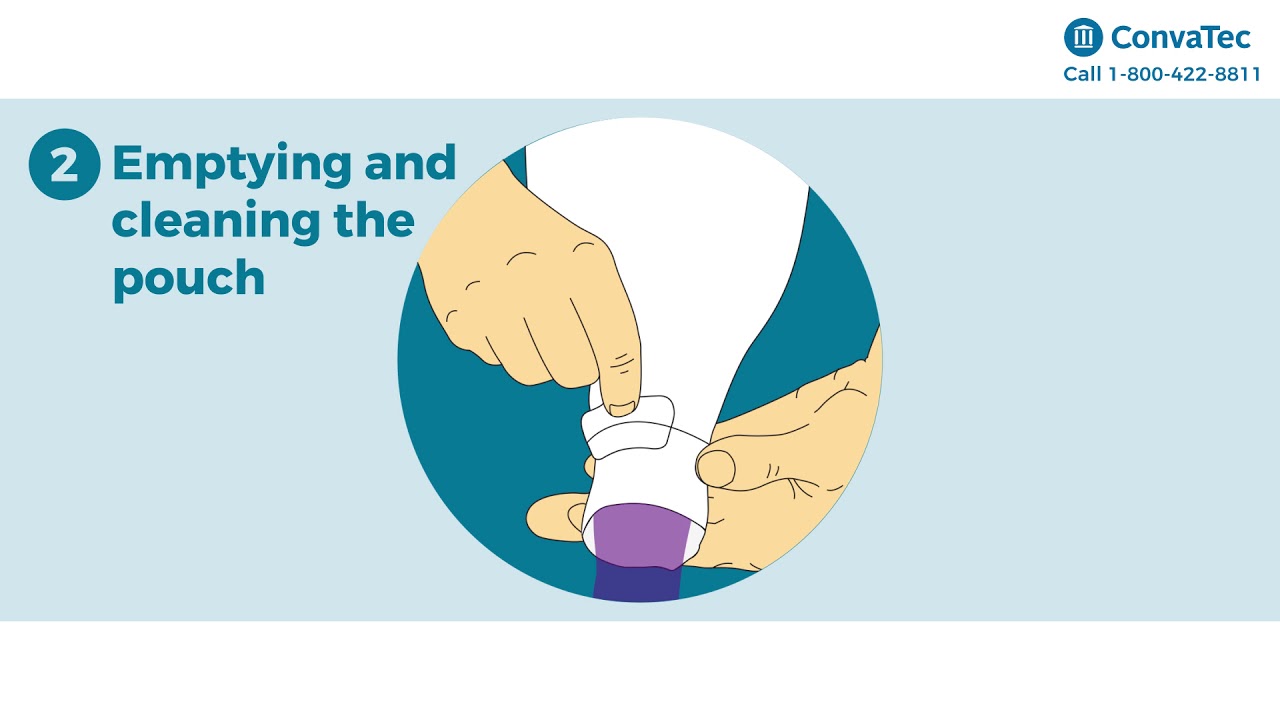 Using the Invisiclose closure on ConvaTec Ostomy pouches