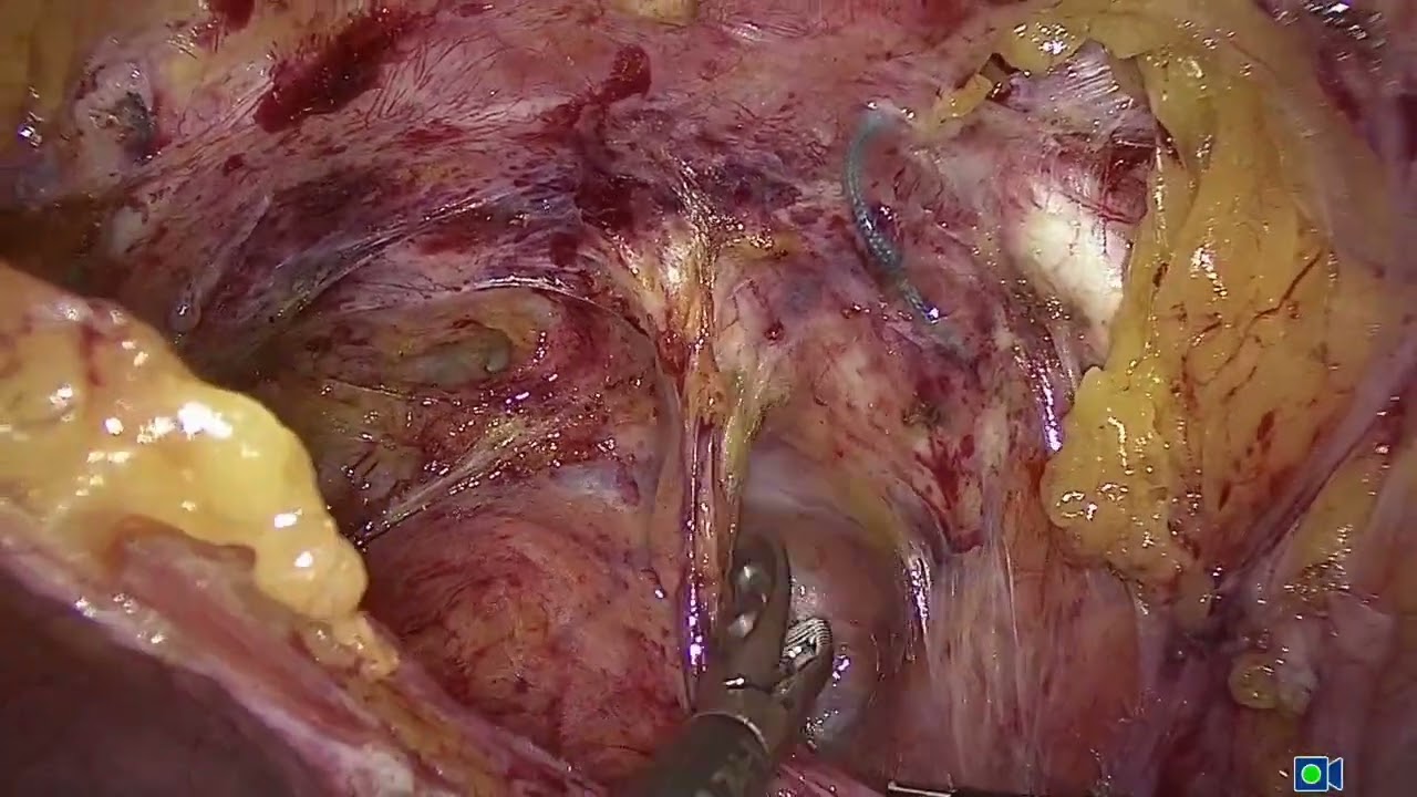 Laparoscopic correction of an insufficient paraurethral Kolposuspension (modified Burch procedure)