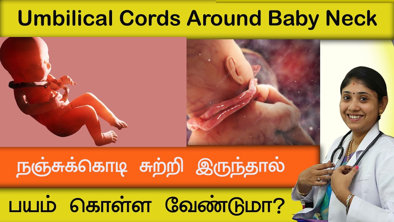 நஞ்சுக்கொடி சுற்றி இருந்தால் பயம் கொள்ள வேண்டுமா? Umbilical Cord Around Baby Neck
