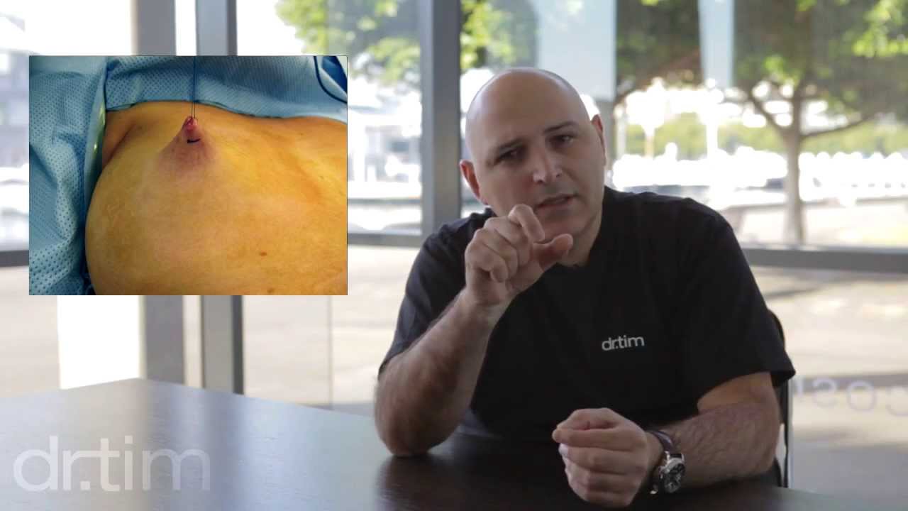 The Inverted Nipple - how to repair inverted nipples