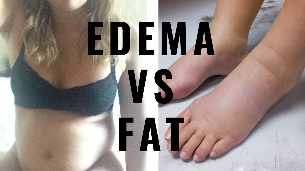 EDEMA VS FAT? + Misunderstanding BODY FAT & it’s ROLE IN OUR HEALTH