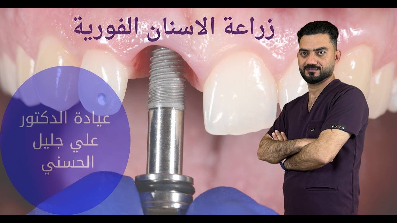 ابتسامة جديدة : زراعة الاسنان الفورية بعد قلع التالفة