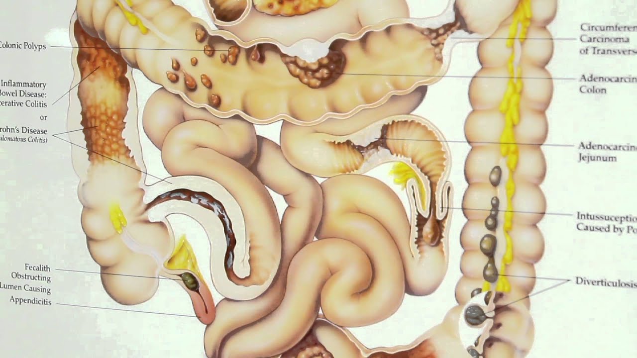 Obstrucciones Gastrointestinales