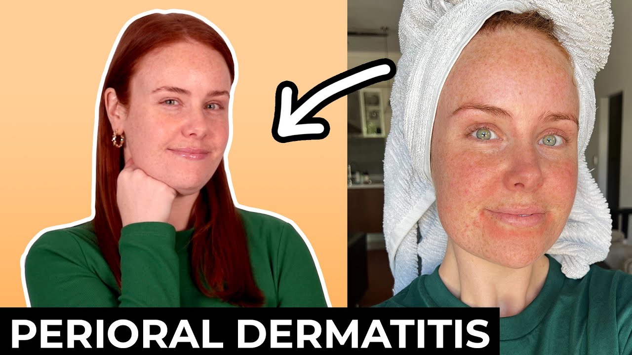 How my skincare routine has changed since getting perioral dermatitis