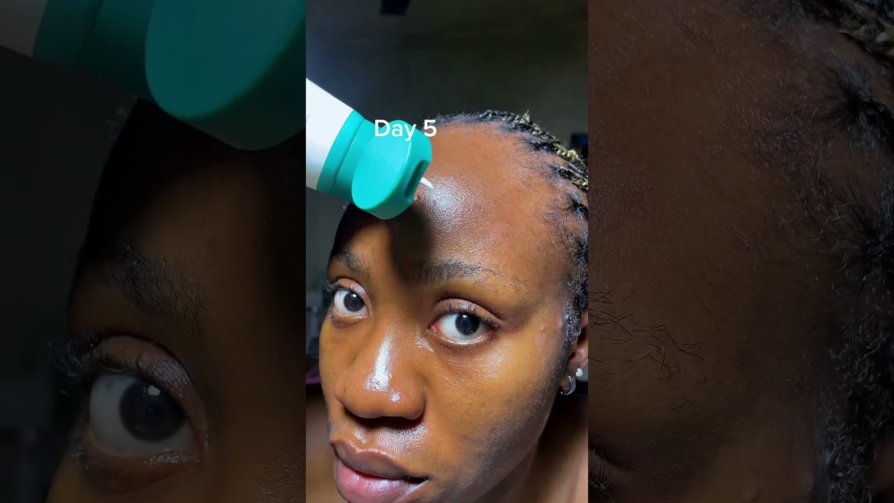 Blemish Out, Glow On ✨ | PURITO Panthenol Cream Challenge